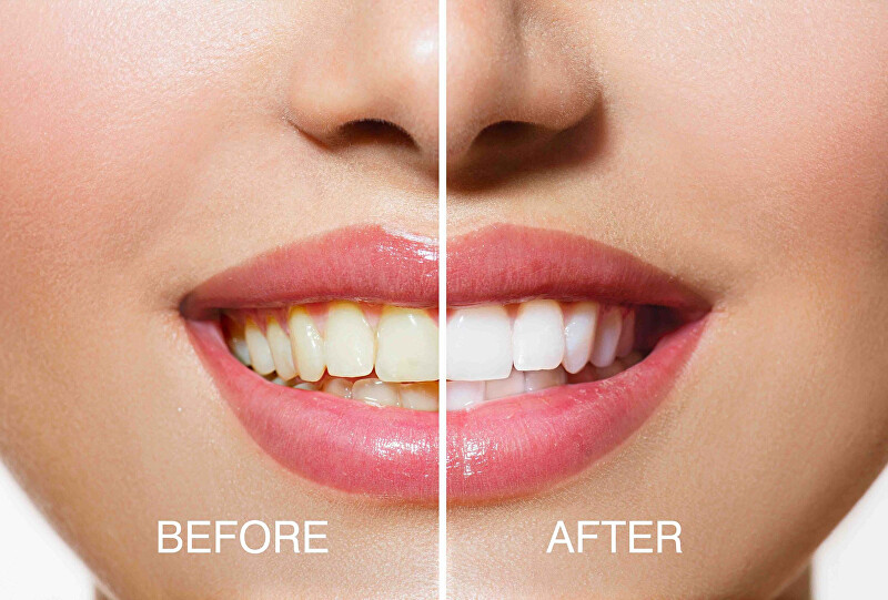 Cestovní lampa na bělení zubů USB Teeth Whitening