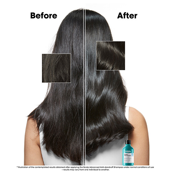 Korpásodás elleni sampon Scalp Advanced (Anti-Dandruff Dermo Clarifier Shampoo)
