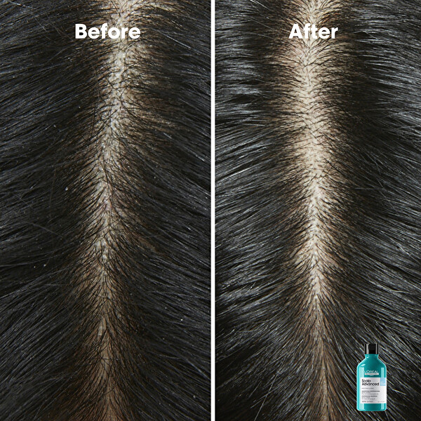 Korpásodás elleni sampon Scalp Advanced (Anti-Dandruff Dermo Clarifier Shampoo)