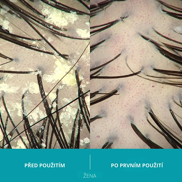 Šampon proti lupům Dandrene (Anti-Dandruff Shampoo) 205 ml
