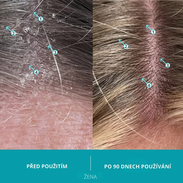 Šampon proti lupům Dandrene (Anti-Dandruff Shampoo) 205 ml