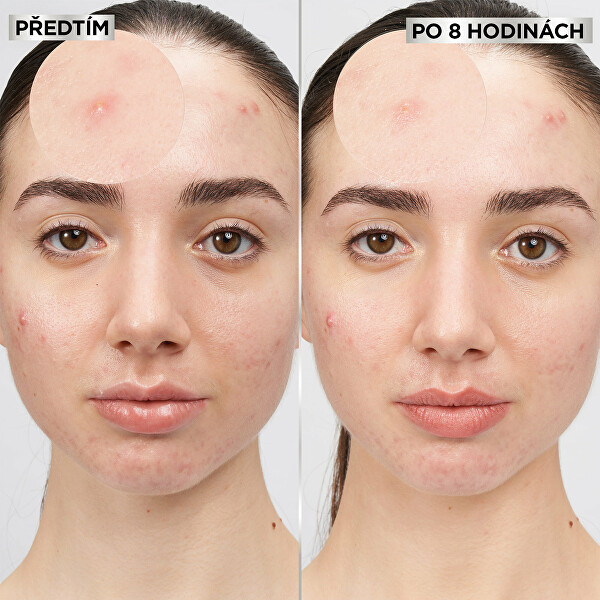 Hydrokoloidní neviditelné náplasti s BHA na nedokonalosti pleti Pure Active (Pimple Patch) 8 ks