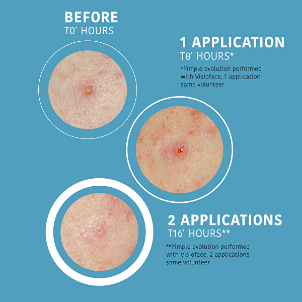 Náplasti na akné a nedokonalosti pleti SOS Pimple Patches 18 ks