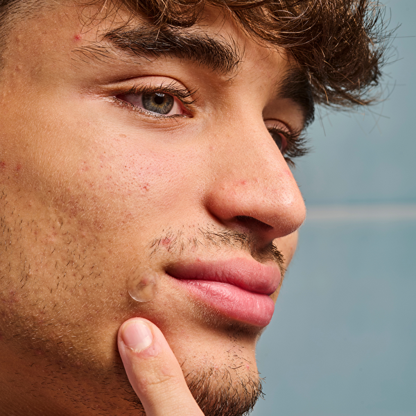 Náplasti na akné a nedokonalosti pleti SOS Pimple Patches 18 ks